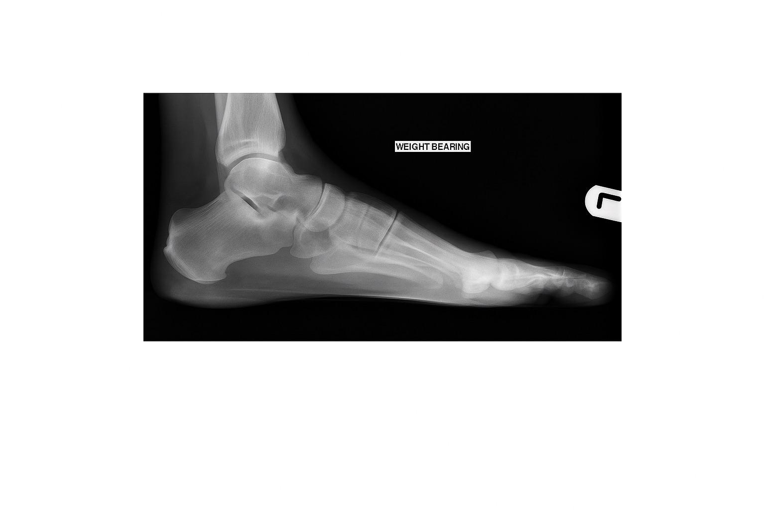 X-ray image showing foot bone structure