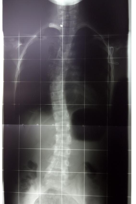 Spine X-ray showing scoliosis curvature